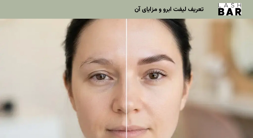 تعریف لیفت ابرو و مزایای آن